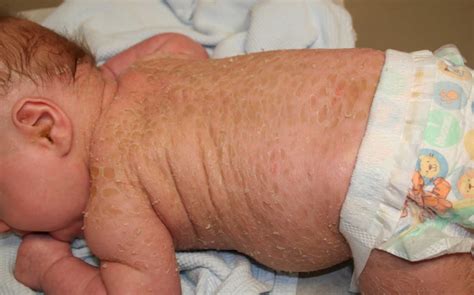 Lamellar ichthyosis causes, symptoms, diagnosis, treatment & prognosis