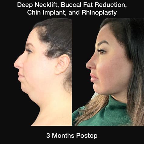 Buccal Fat Removal St. Louis, MO | Nayak Plastic Surgery