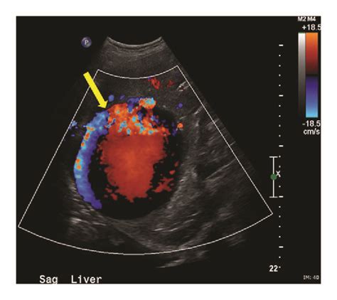 Color Doppler ultrasound demonstrating bidirectional blood flow within ...
