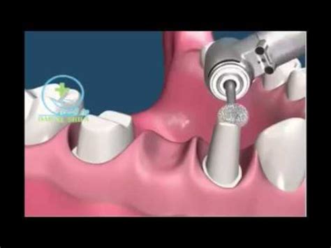 Dental Bridge Procedure Step by Step - YouTube