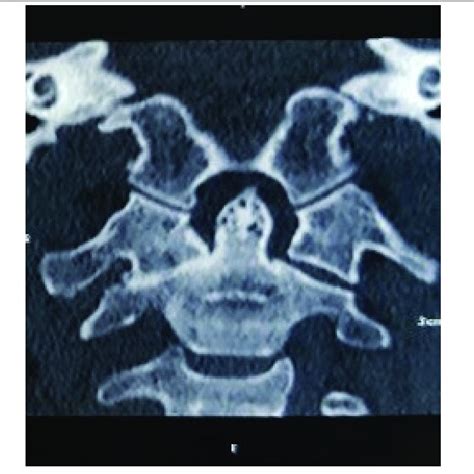 Computed Tomography showed autofusion of the lateral atlantoaxial joint ...