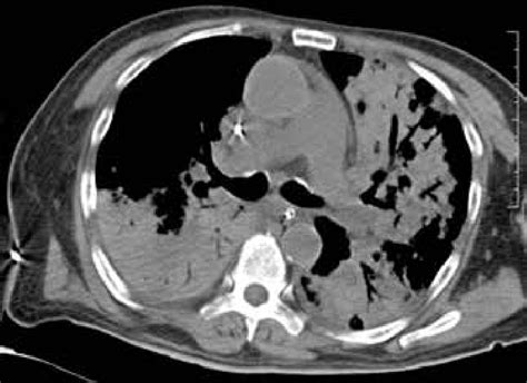 CT scan showing diffuse air space opacities with air bronchogram in... | Download Scientific Diagram