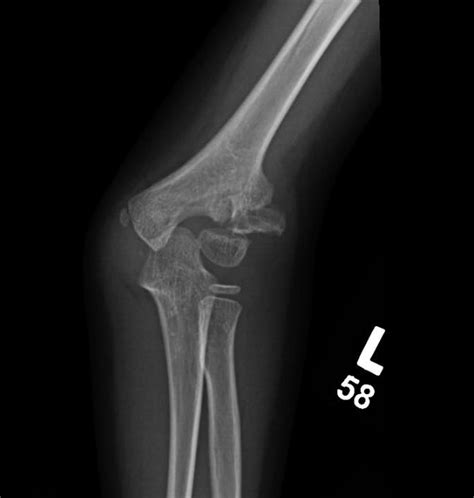 Pediatric Lateral Condyle Fracture | Images and Photos finder