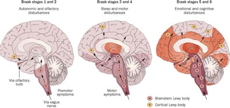 polvere Allungare Continuo what causes lewy body dementia Di base ...