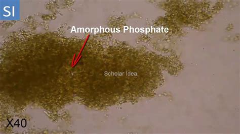 Amorphous Phosphate Crystals in Urine !!! - YouTube