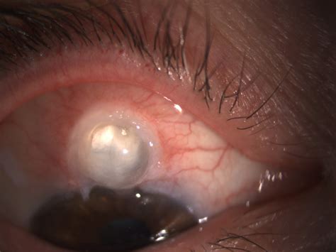 This post trabeculectomy bleb – Glaucoma – Advanced Eye Surgery Scotland Forum