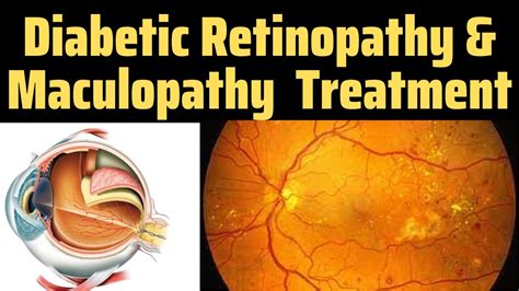 Diabetic Retinopathy Optos | Drss Eye | Diabetic Retinopathy Treatment | Maculopathy Treatment ...