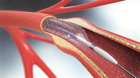 Carotid Endarterectomy and Stenting - Sentara