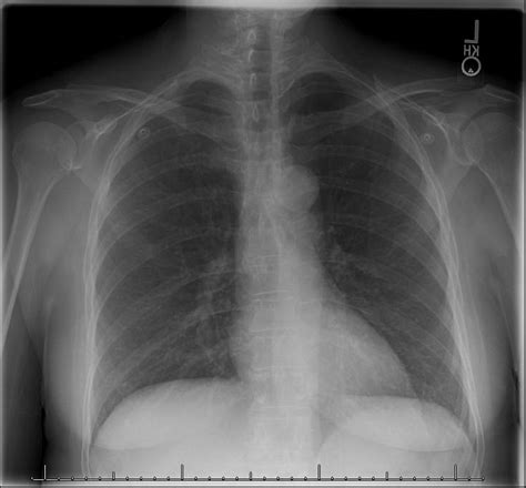 Hennepin Ultrasound | Sternal Fracture Missed on X-ray