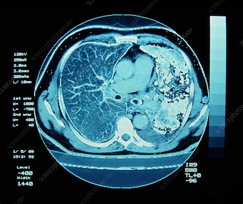 CT scan on chest showing lung cancer - Stock Image - M134/0071 - Science Photo Library