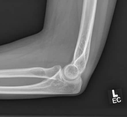 Radial tuberosity pseudocyst | Radiology Case | Radiopaedia.org