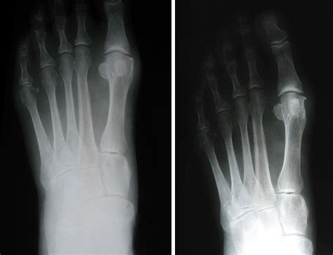 Bunion Surgery - OrthoInfo - AAOS