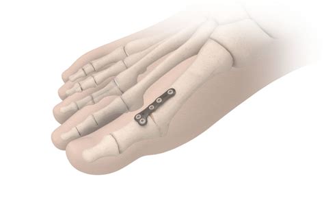 BioPro Hemi Toe Implant for Hallux Rigidus (2022)