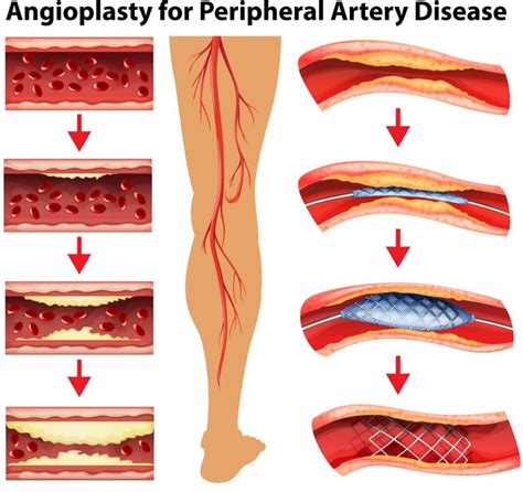 Leg angioplasty for PAD in Hyderabad - Dr. Malleswara Rao