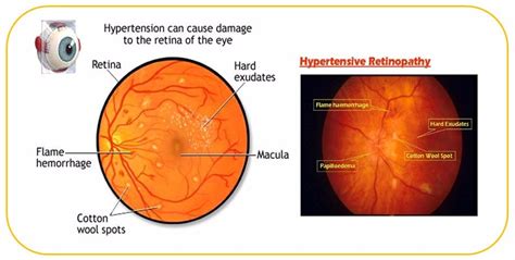 Hypertensive retinopathy management