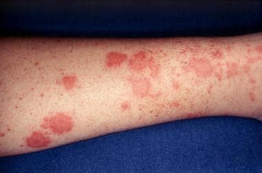 nodular vasculitis - pictures, photos