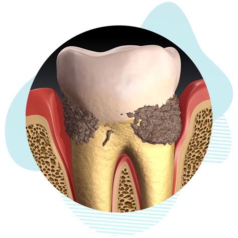 Gum Disease Treatment | Paradise Dental Associates | Salem, MA