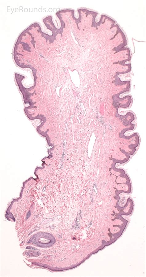 Benign Lesions of the External Periocular Tissues
