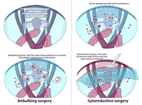 Ovarian Cancer Specialist in Ahmedabad | HIPEC & Cytoreductive Surgery for Ovarian Cancer