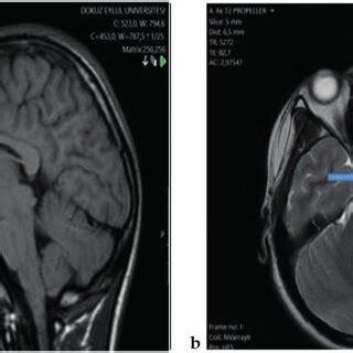 MRI brain scans of patient number 7. a. Midsagittal T1-weighted image... | Download Scientific ...