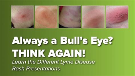 Think the Lyme Disease Rash is Always a Bullseye? THINK AGAIN! : Johns Hopkins Lyme Disease ...