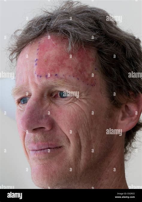 man sun damage treatment Stock Photo - Alamy