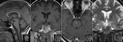 Radiology MRI: Tuber Cinereum Hamartoma