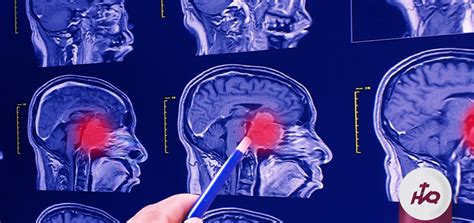 Tumor cerebral - Hospital Vozandes