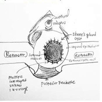 Marsupialization of Skene’s Gland Cyst