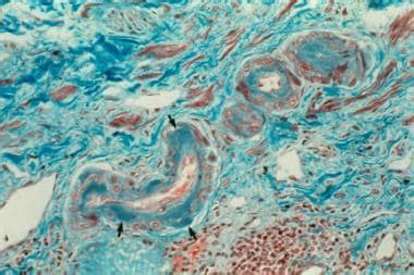 Nephrosclerosis: Background, Pathophysiology, Epidemiology