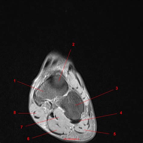 MRI of the Ankle: Detailed Anatomy - W-Radiology