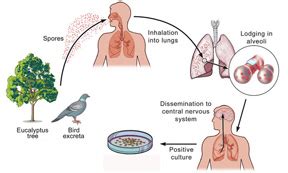 Psittacosis