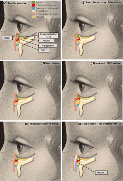 Recommendations for the treatment of tear trough deformity with cross‐linked hyaluronic acid ...