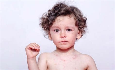 My Child Has an Egg Allergy: What Should I Do? - You are Mom