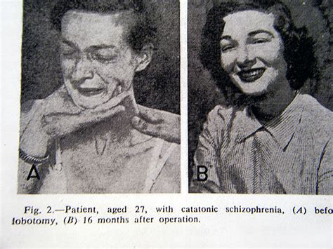 These 21 Before And After Photos Of People Who Underwent Lobotomies Are ...