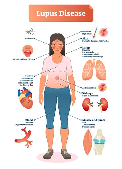 Lupus Symptoms; 10 Warning Signs and Symptoms of Lupus - Healthella