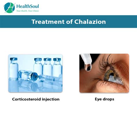 Chalazion – Healthsoul