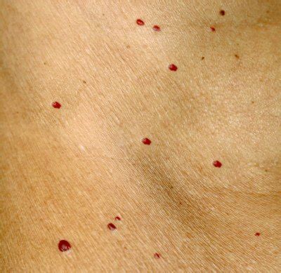 What Those Tiny Red Dots on Your Skin Might Mean » Scary Symptoms