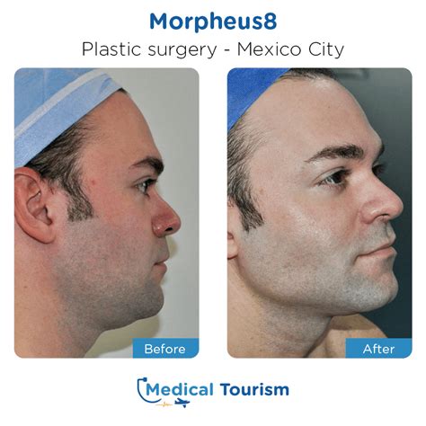 Reviews For Plastic Surgery In Mexico City | Medical Tourism Mexico