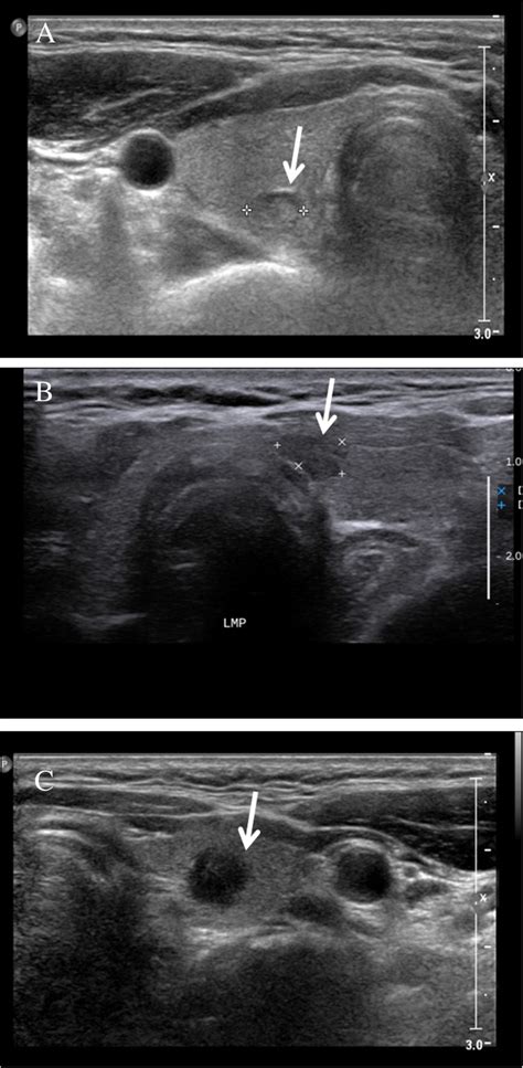 Echogenicity of thyroid cancer (arrow). (A) Isoechoic nodule on the... | Download Scientific Diagram