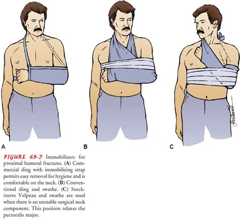 Humeral Neck - Fracture