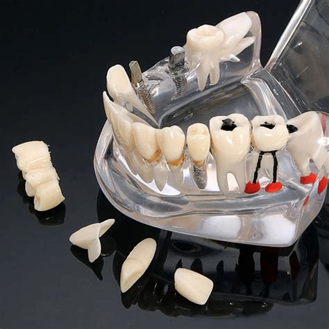 Dental model dental implant model active tooth model pathological tooth ...