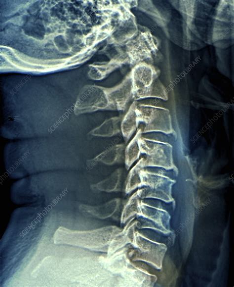 Spinal arthritis, X-ray - Stock Image - C047/2056 - Science Photo Library