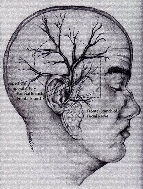 Temporal Arteritis aka Giant Cell Arteritis and Temporal Artery Biopsy ...