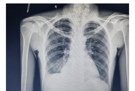 Chest Radiograph at diagnosis showing blunting of right costophrenic... | Download Scientific ...