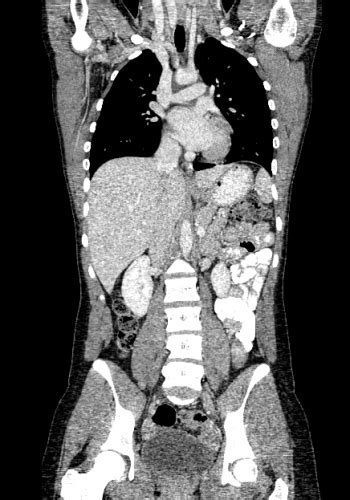 Female Abdominal Pelvic CT Scan - Abdomen and Pelvis CTs - embodi3D.com