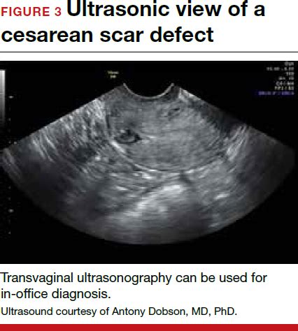 Cesarean scar defect: What is it and how should it be treated? | MDedge ...