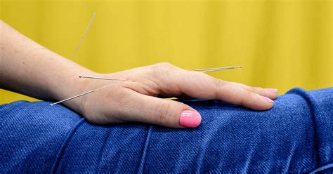 Acupuncture for Psoriasis: Does It Help?