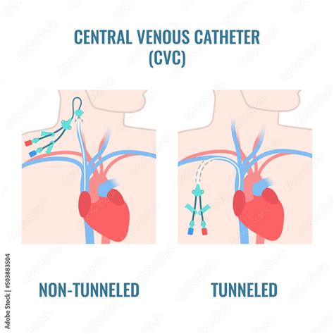 Non Tunneled Central Venous Catheter