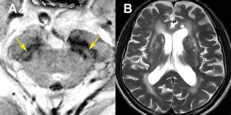 Imaging the Substantia Nigra in Parkinson Disease and Other Parkinsonian Syndromes | Radiology